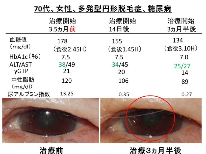 円形脱毛症　病院